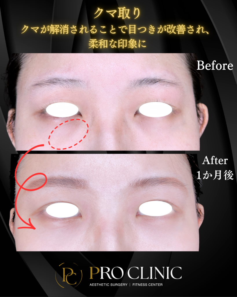 プロクリニックのクマ取りの症例（1か月後・正面）