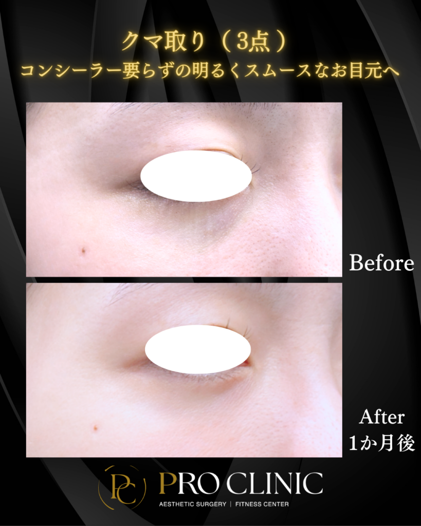 プロクリニックのクマ取り（3点）の症例（1か月後・斜角）