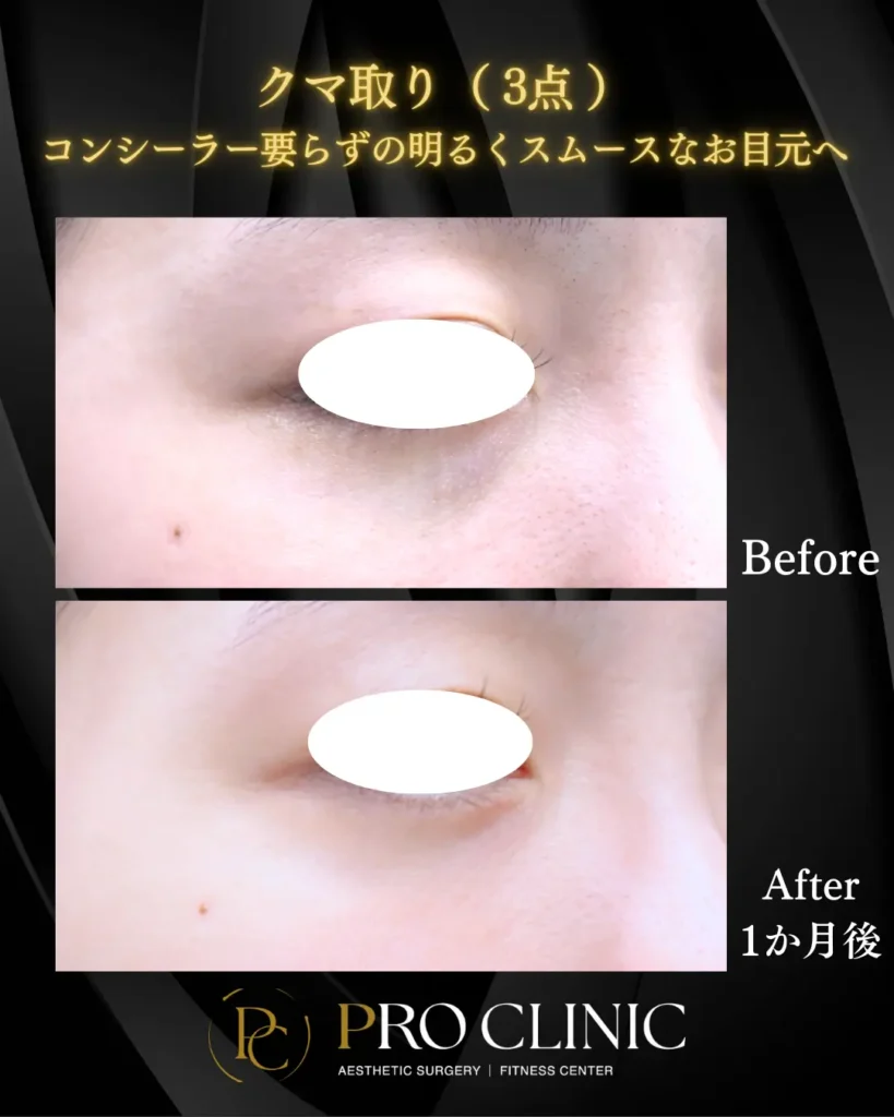 プロクリニックのクマ取り（3点）の症例（1か月後・斜角）