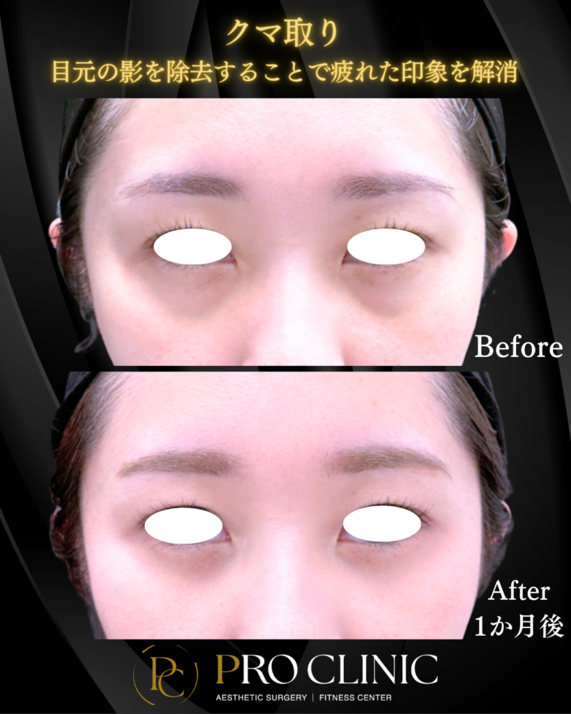 プロクリニックのクマ取りの症例（1か月後・正面）