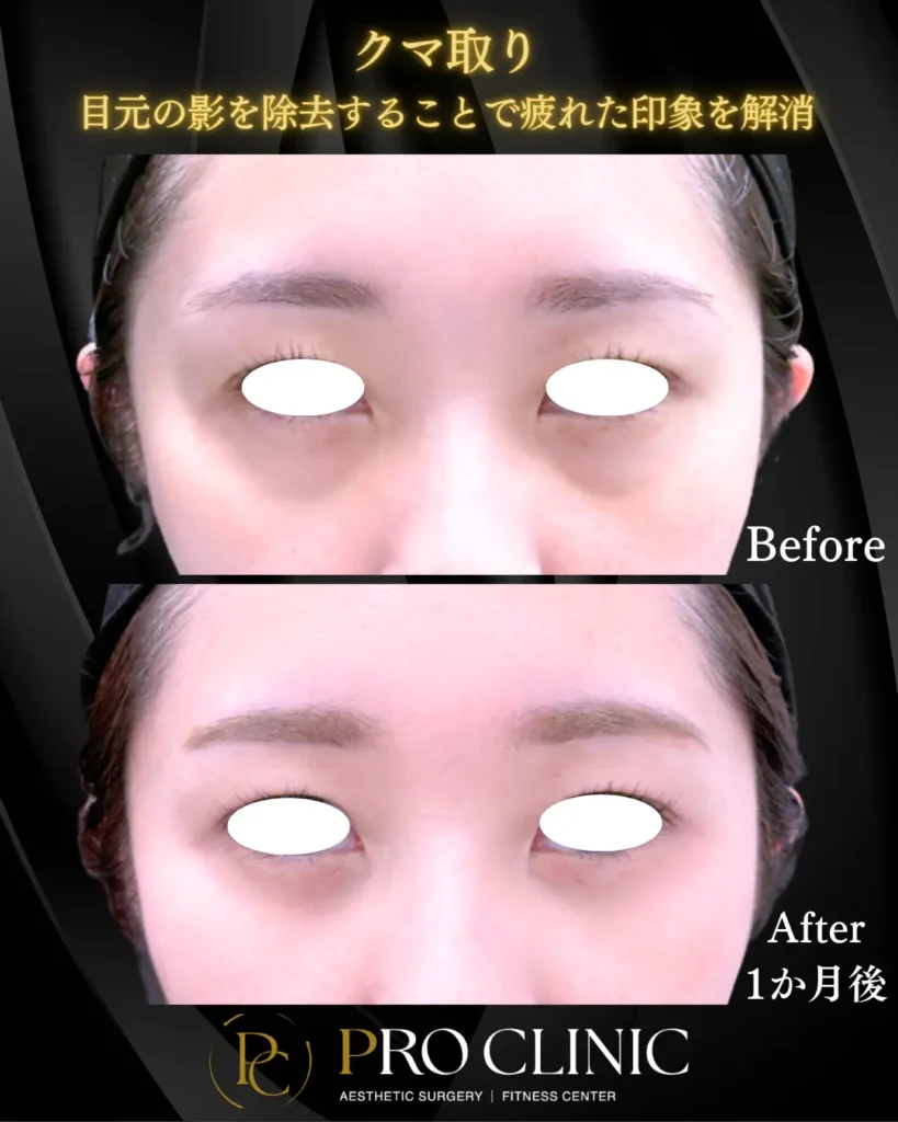 プロクリニックのクマ取りの症例（1か月後・正面）