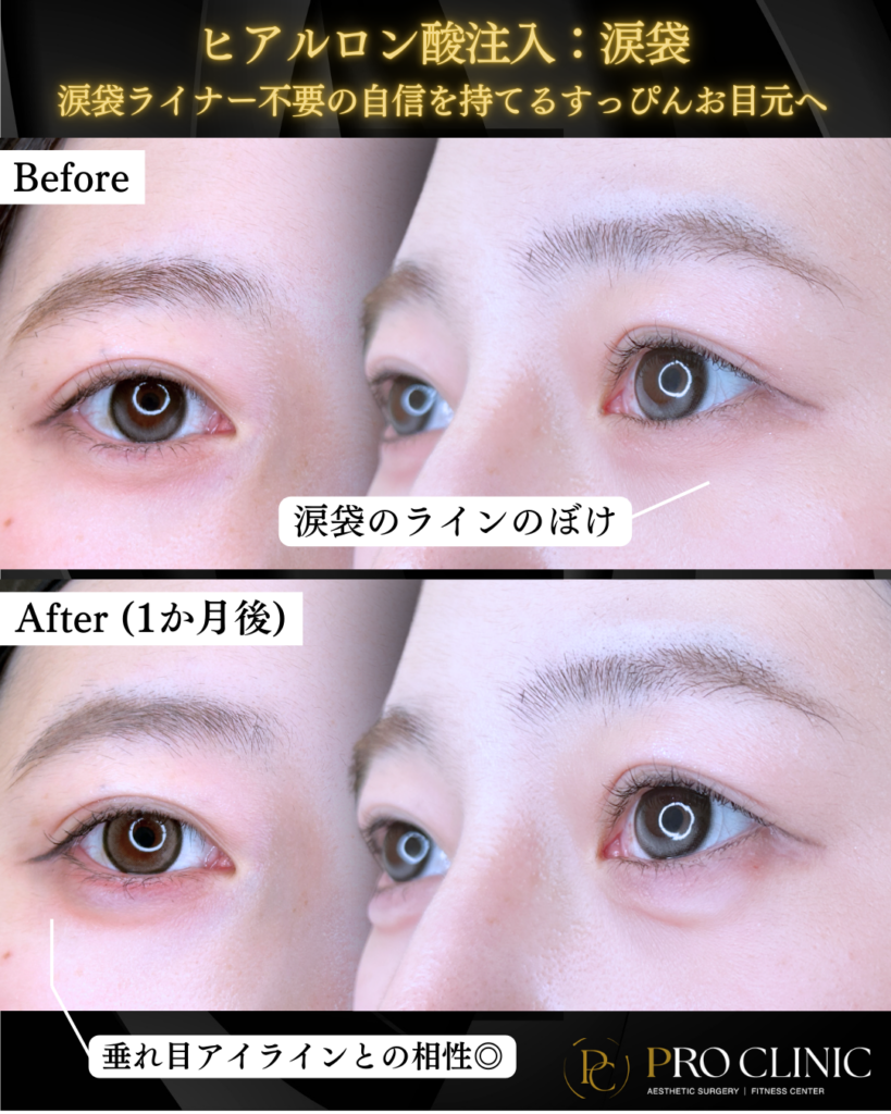 プロクリニックの涙袋ヒアルロン酸注入の症例（1か月後）