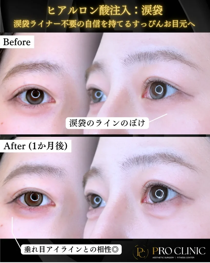 プロクリニックの涙袋ヒアルロン酸注入の症例（1か月後）