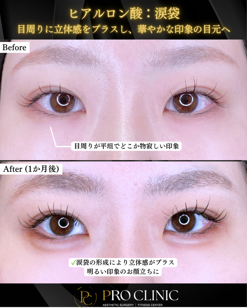 プロクリニックの涙袋ヒアルロン酸注入の症例（1か月後）