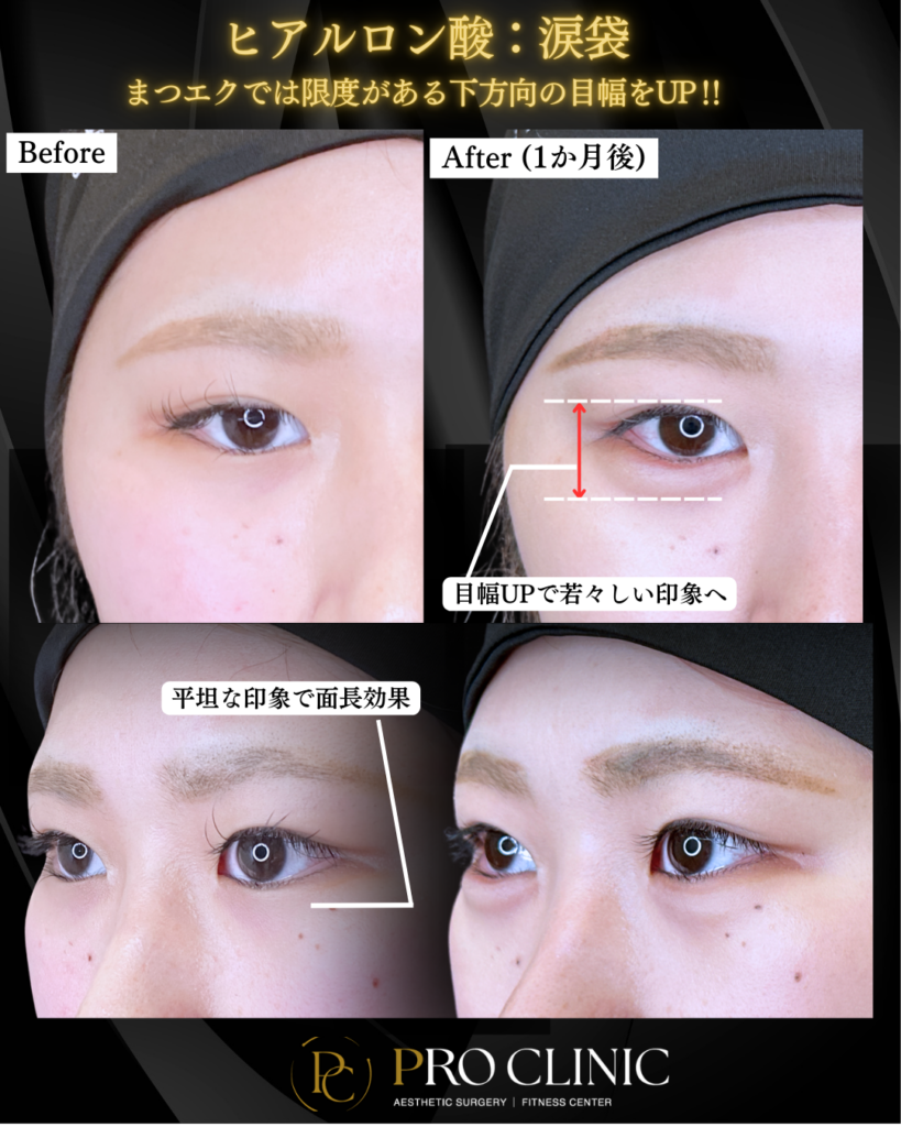 プロクリニックの涙袋ヒアルロン酸注入の症例（1か月後）