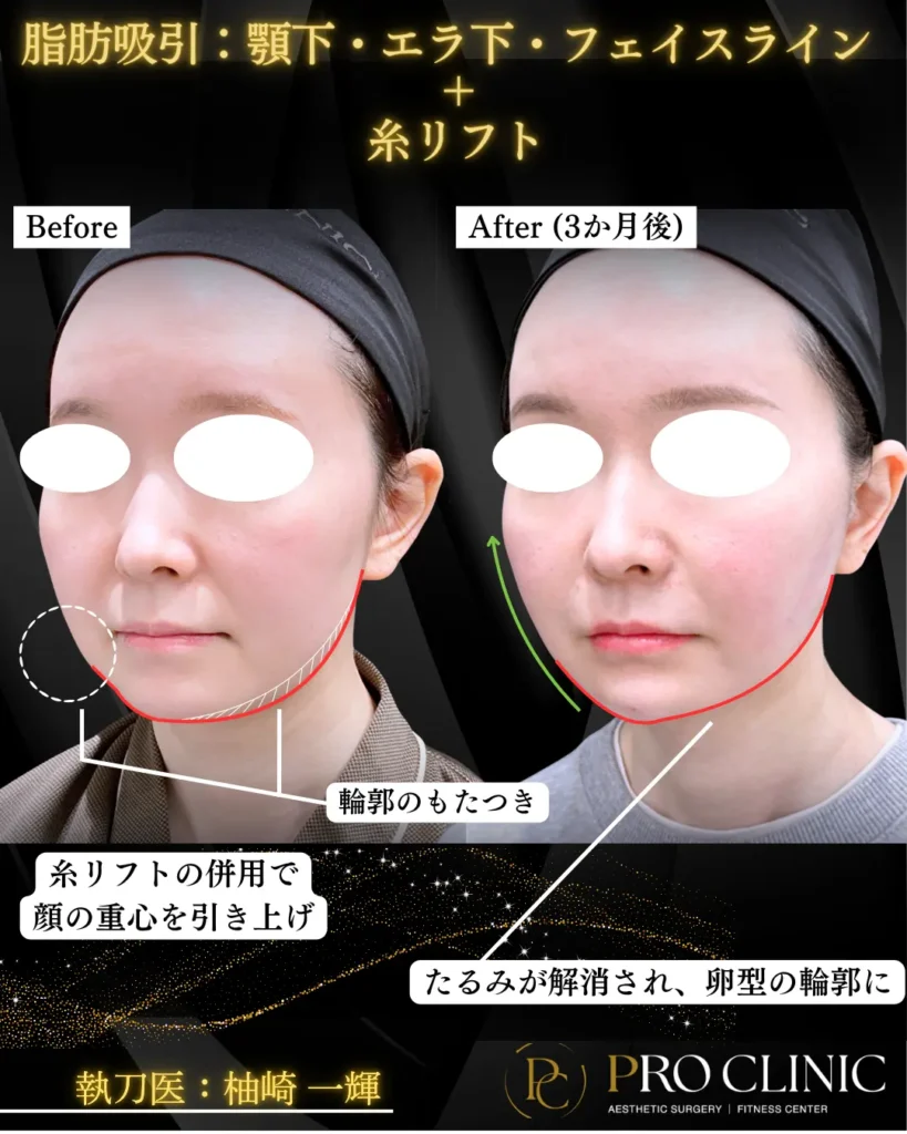 プロクリニックの脂肪吸引＋糸リフトの症例（3か月後・斜角）