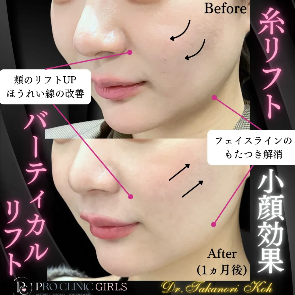 プロクリニックのバーティカルリフトの症例（1か月後・斜角）