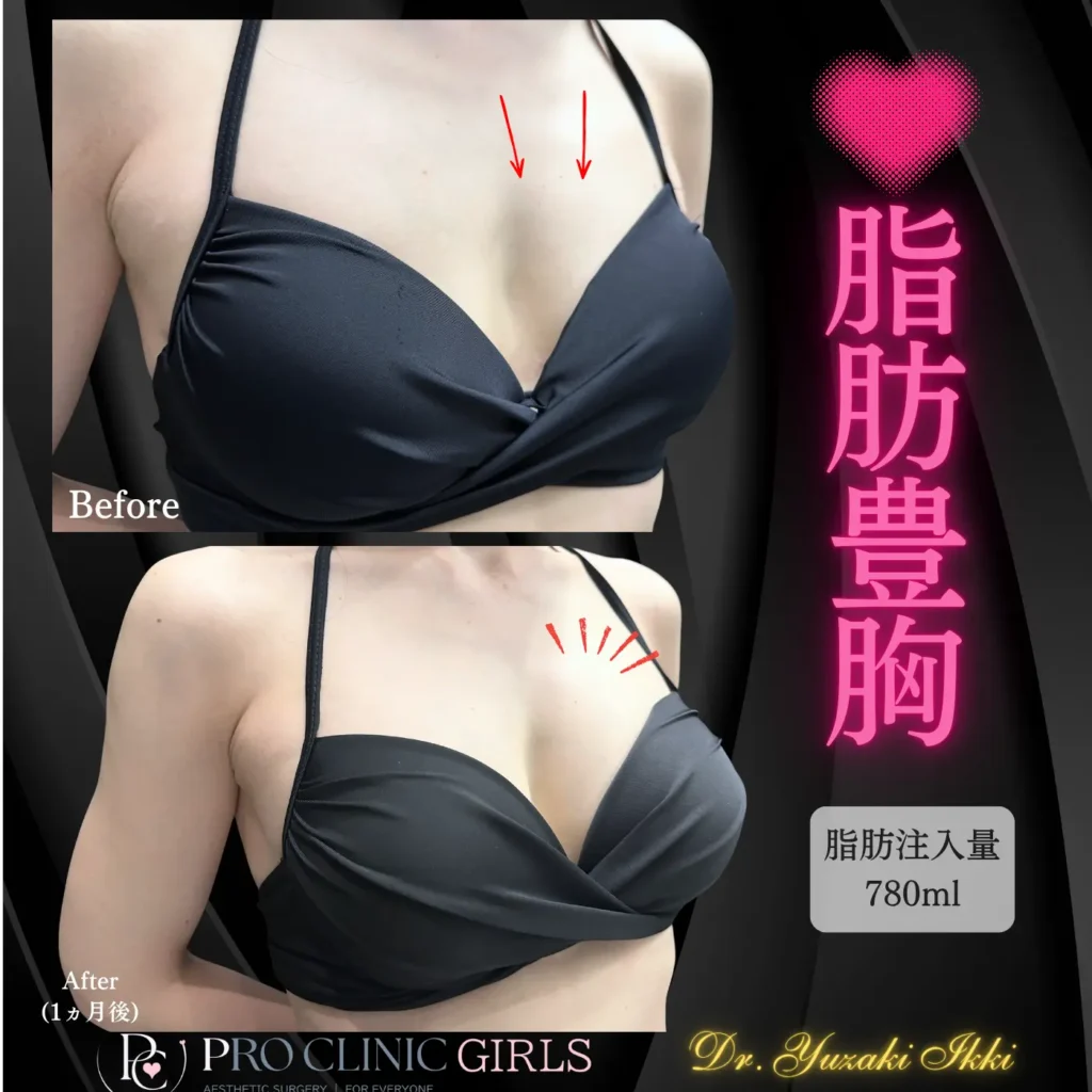 プロクリニックの脂肪豊胸の症例（1ヵ月後・斜角）