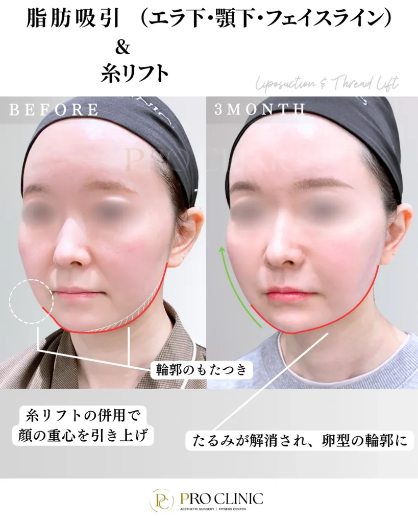プロクリニックの脂肪吸引(エラ下・顎下・フェイスライン)&糸リフトの症例(3か月後・斜角)